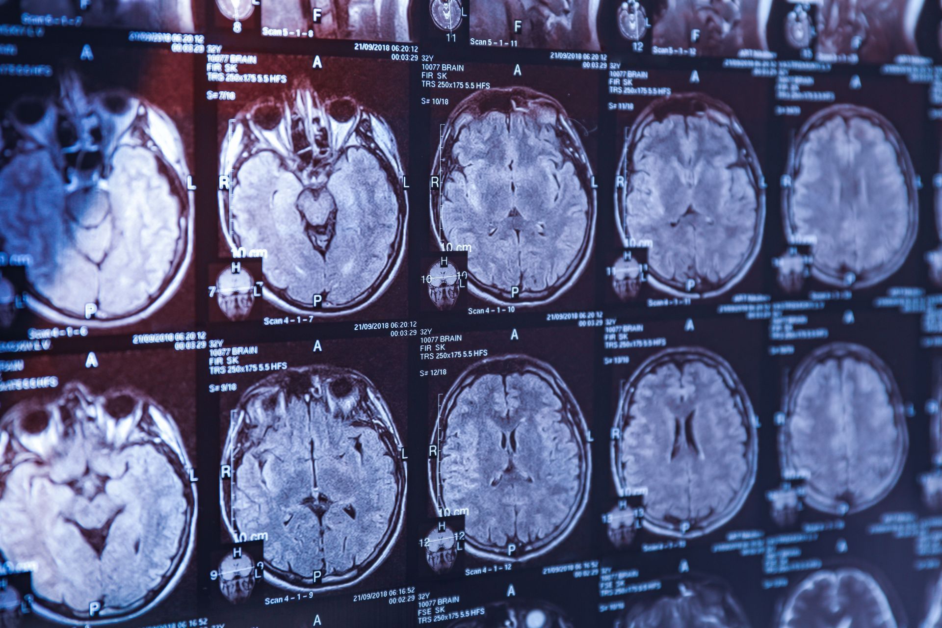 Coenzyme Q10 and neurodegenerative diseases - what are the relationships?